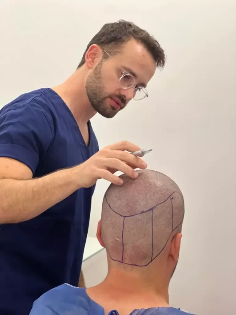 FUE: Transplante Capilar mais realizado entre os Homens, Conheça!