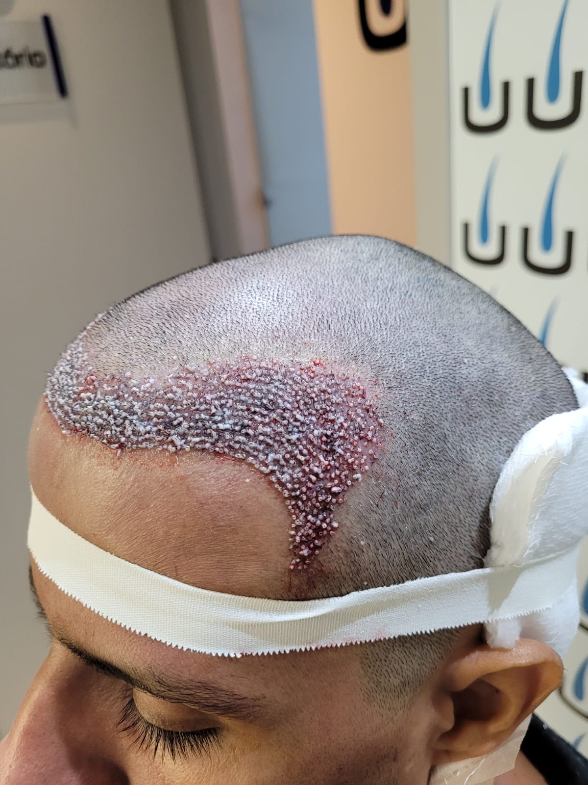 FUE vs FUT: Qual o Melhor Método de Transplante Capilar Hoje? Com os avanços da estética, dois métodos se destacam como os principais...